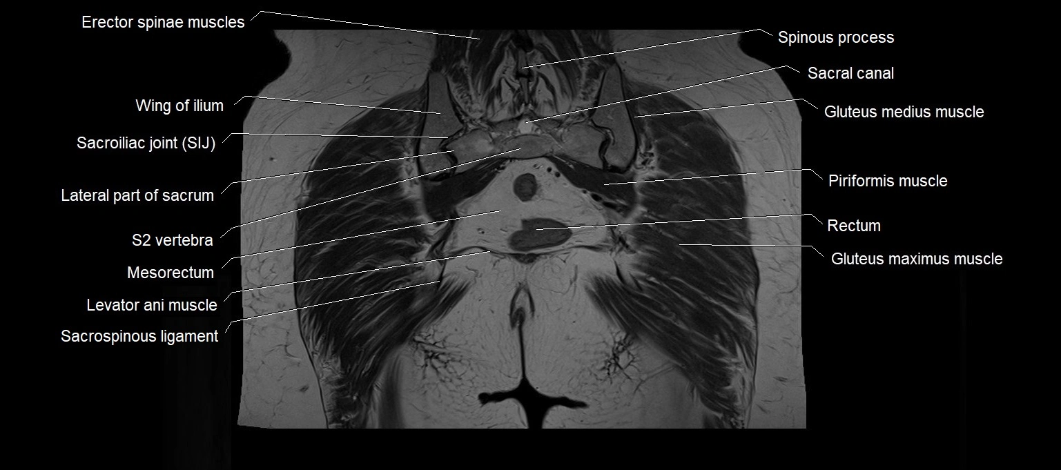MRI 3T pelvis coronal cross section anatomy image 22.webp